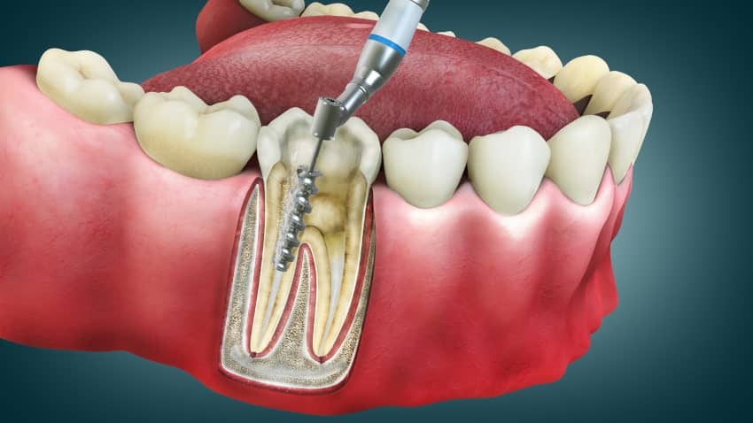Root Canal in Kansas City