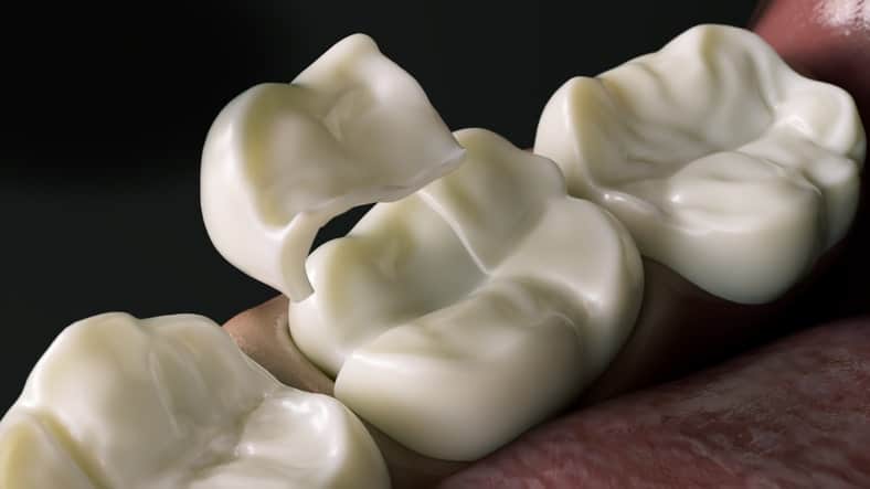 Dental Inlays and Onlays in Kansas City